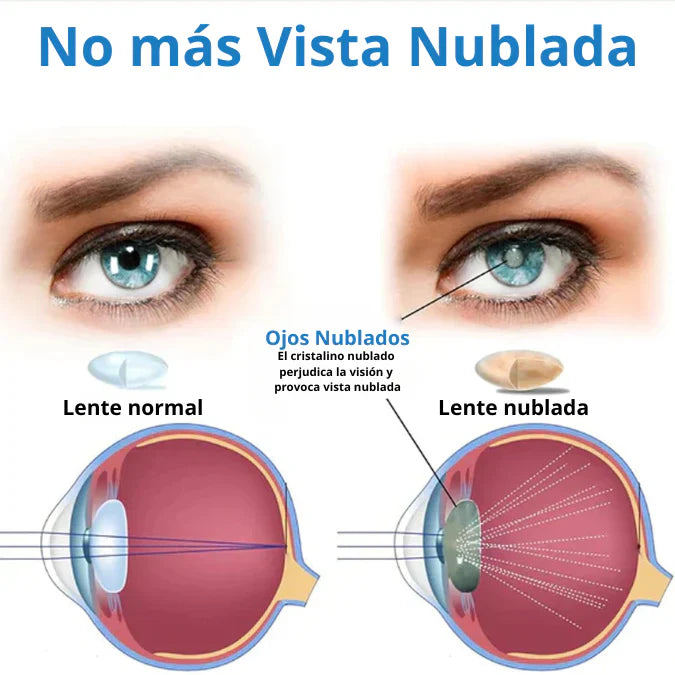 GOTAS OFTÁLMICAS MILAGROSAS PARA PROBLEMAS DE OJOS